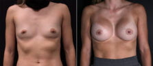 breast-augmentation-100a-buford