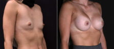 breast-augmentation-100b-buford