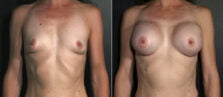 breast-augmentation-101a-buford
