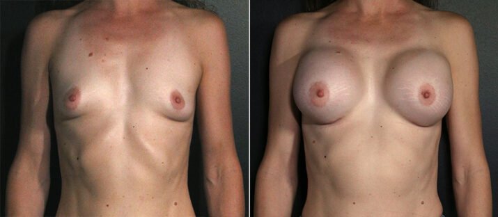 Breast Augmentation 30