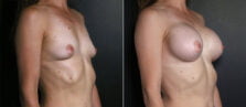 breast-augmentation-101b-buford