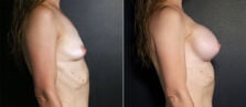 breast-augmentation-101c-buford