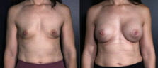 breast-augmentation-102a-buford