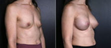 breast-augmentation-102b-buford