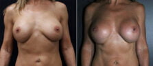 breast-augmentation-103a-buford