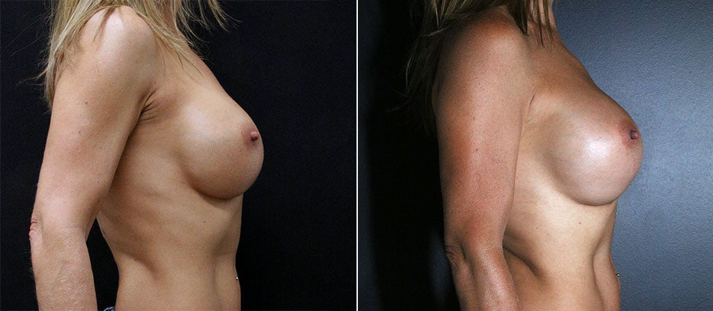 Breast Augmentation 32