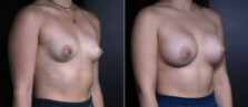 breast-augmentation-104b-buford