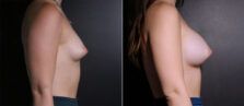 breast-augmentation-104c-buford