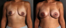 breast-augmentation-105a-buford