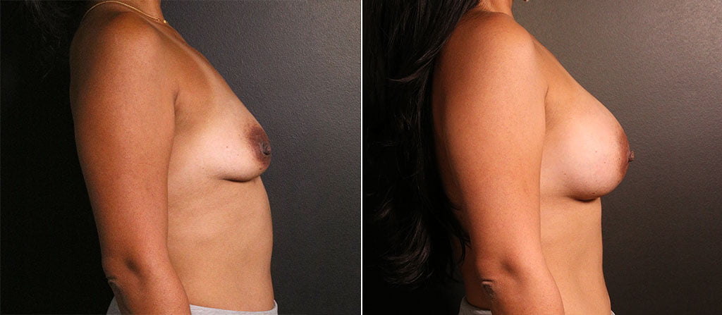 Breast Augmentation 34