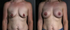 breast-augmentation-106a-buford