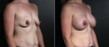 breast-augmentation-106b-buford
