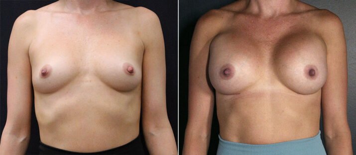 Breast Augmentation 36