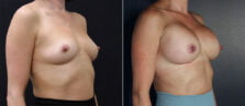 breast-augmentation-107b-buford