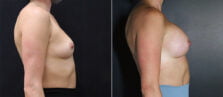 breast-augmentation-107c-buford