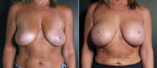 breast-augmentation-108a-buford