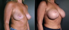 breast-augmentation-108b-buford