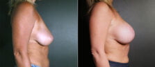 breast-augmentation-108c-buford