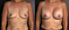 breast-augmentation-109a-buford