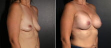 breast-augmentation-109b-buford
