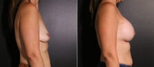 breast-augmentation-109c-buford