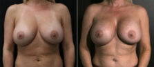 breast-augmentation-110a-buford