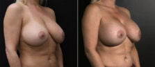 breast-augmentation-110b-buford