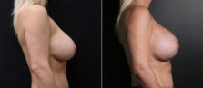 breast-augmentation-110c-buford
