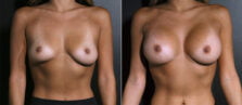 breast-augmentation-111a-buford