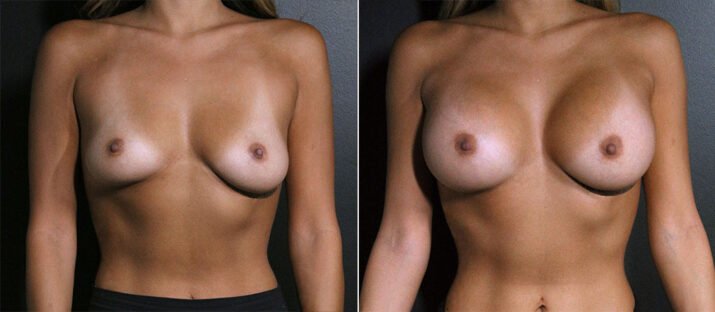 Breast Augmentation 40