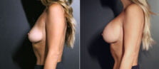 breast-augmentation-111c-buford