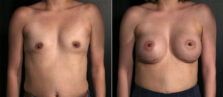 breast-augmentation-112a-buford