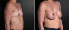 breast-augmentation-112b-buford