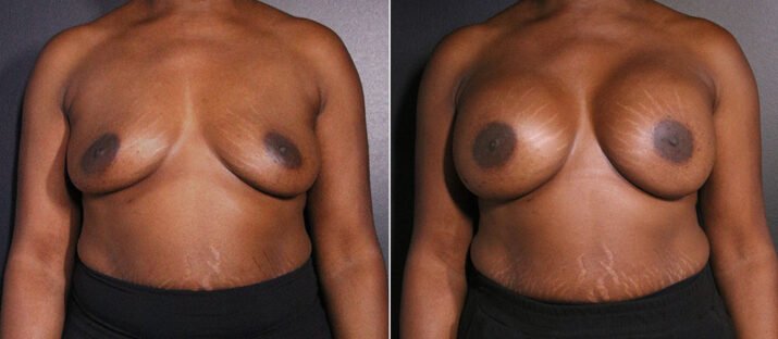 Breast Augmentation 42