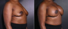 breast-augmentation-113b-buford