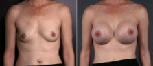 breast-augmentation-114a-buford