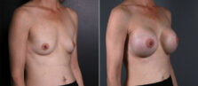 breast-augmentation-114b-buford