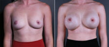 breast-augmentation-115a-buford
