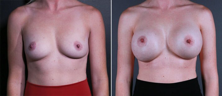 Breast Augmentation 44