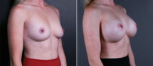 breast-augmentation-115b-buford