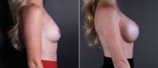 breast-augmentation-115c-buford