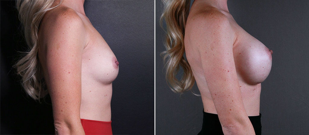 Breast Augmentation 44