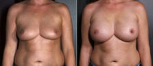 breast-augmentation-116a-buford