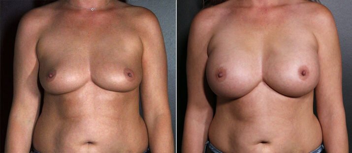 Breast Augmentation 45