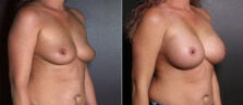 breast-augmentation-116b-buford
