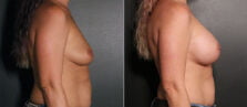 breast-augmentation-116c-buford