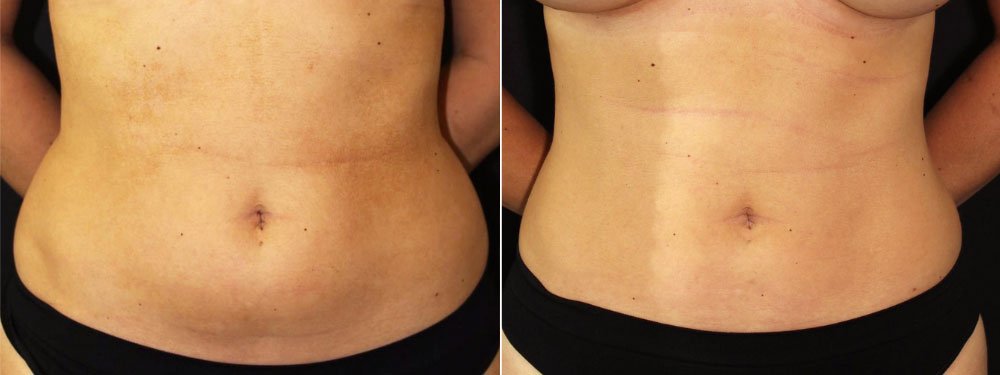 Who Is a Good Candidate for Liposuction?