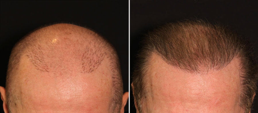 NeoGraft Hair Transplant for Men