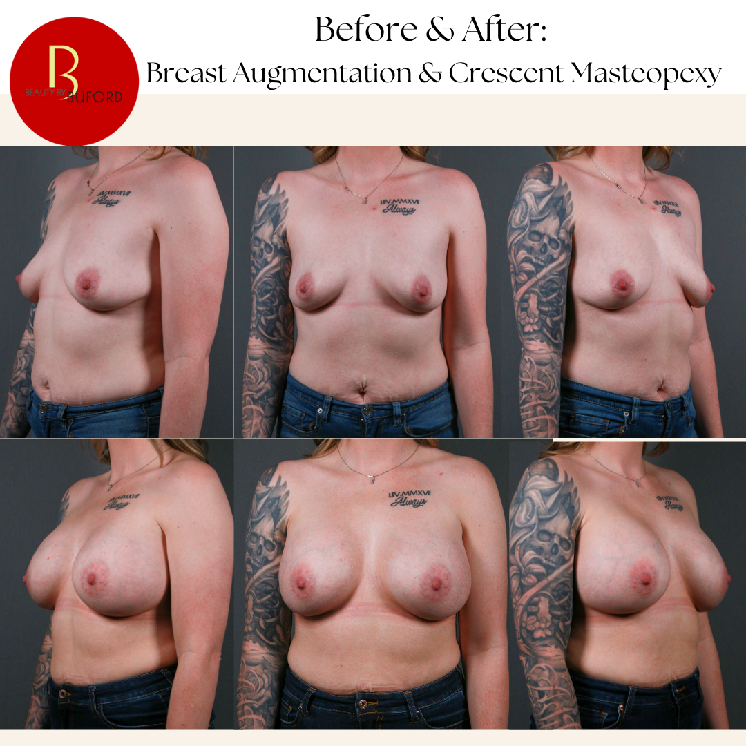Breast Augmentation 50