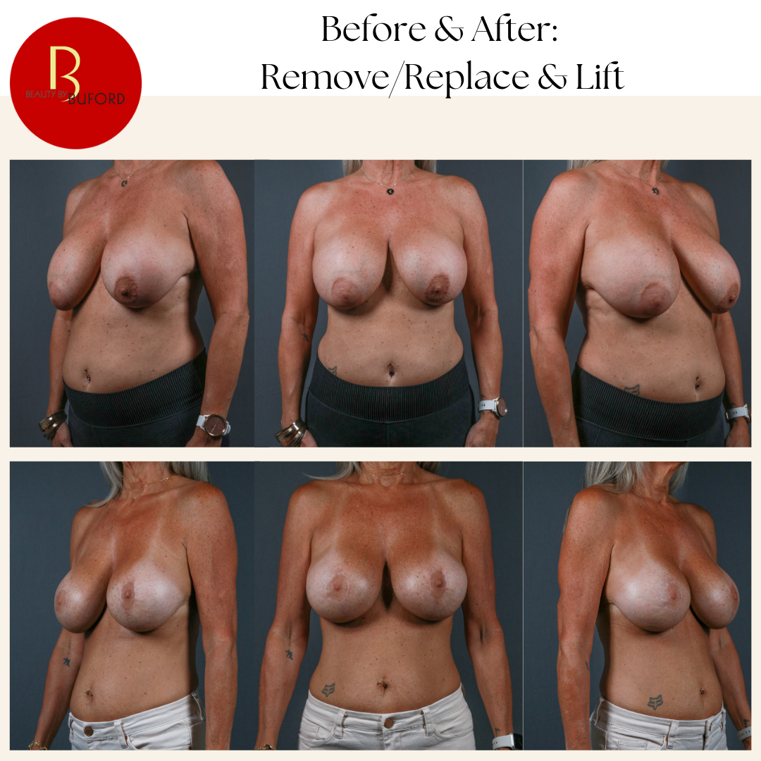 Breast Implant Removal + Lift 2
